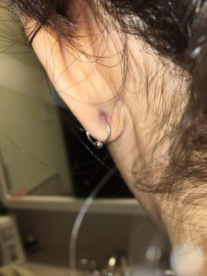 Levon's piercing work. Bruised earlobes from the forceps.