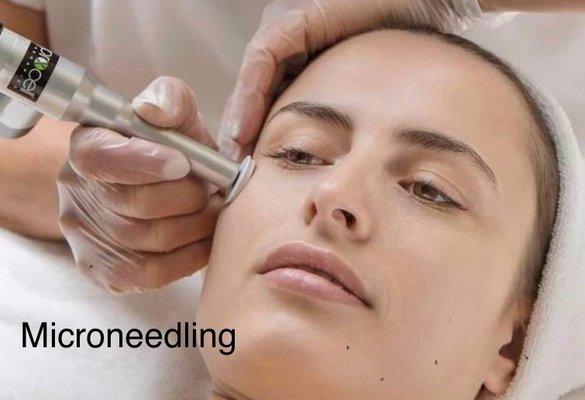 Microneedling Treatment