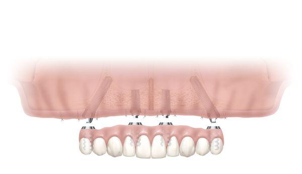 All-on-Four dental implants procedure