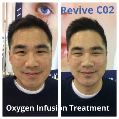 Oxygen treatment for acne and pigmentation.