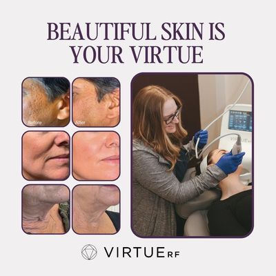 Virtue RF Microneedling