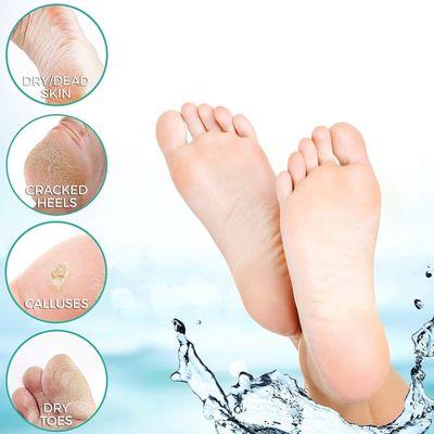 Foot chemical peel