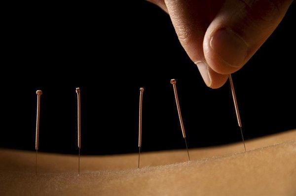 Needle treatment reduce the back pain