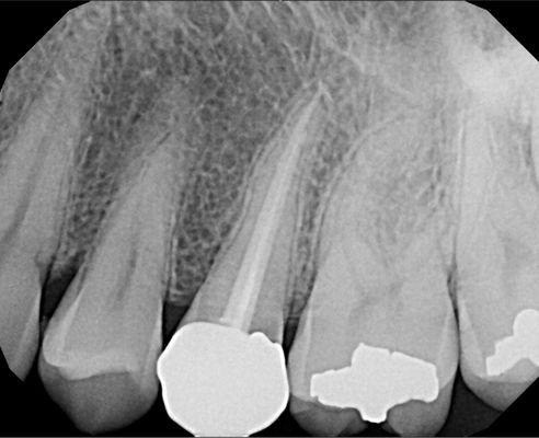 Pain Free- Laser assisted root canal therapy