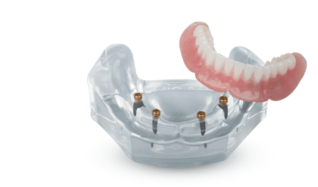 Implant Dentures