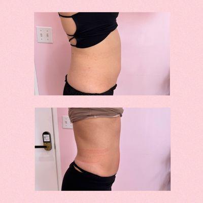 2 sessions of Lemon Bottle and 4 sessions of body contouring