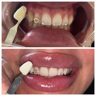 1 session of teeth whitening. 8 shades difference.