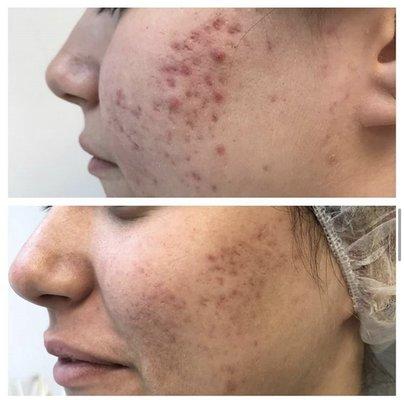 Acne treatment combining PRP with microneedling