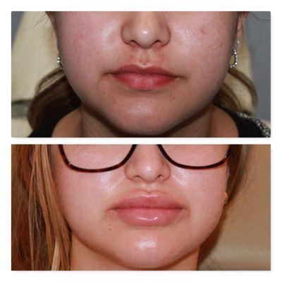 Lip filler and lip flip with Botox and juvederm