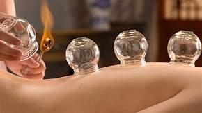 Cupping therapy available!