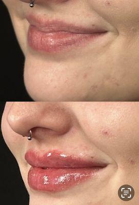 1 syringe of lip filler gives a natural plumbing and hydration of the lips.