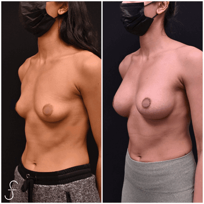 Breast Augmentation