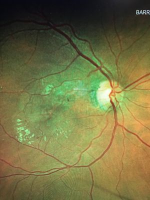 Optos image of diabetic retinopathy