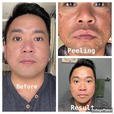 Chemical peel