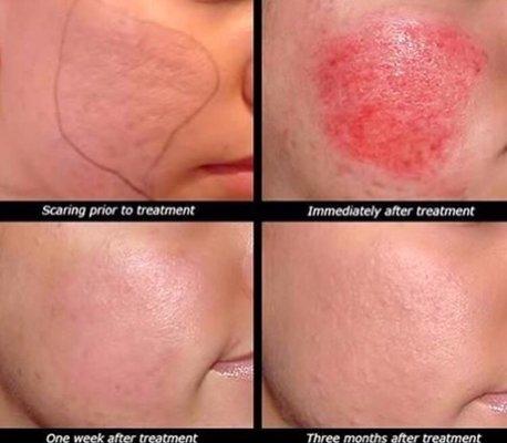 Before/after microneedling