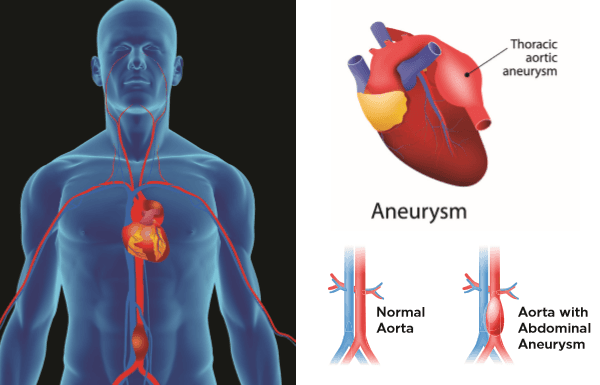 Aortic Aneurysm Program_RWJ Barnabas Health