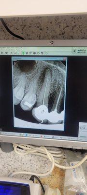 upper K-9 tooth root canal