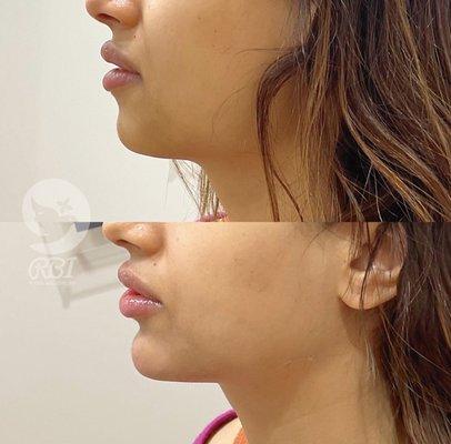 Chin contouring  @rejuvenationbyirina