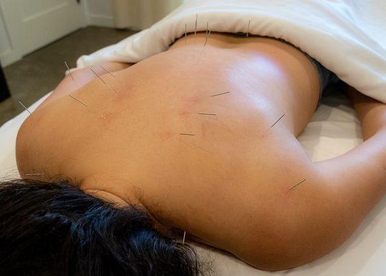 This relaxing acupuncture treatment releases muscle tension, calms the mind and alleviates stress.