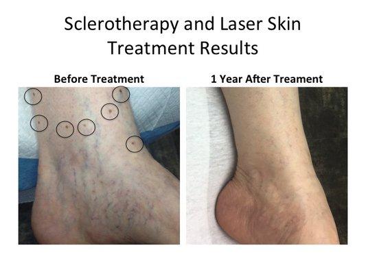 Sun damage and vein treated by laser and sclerotherapy