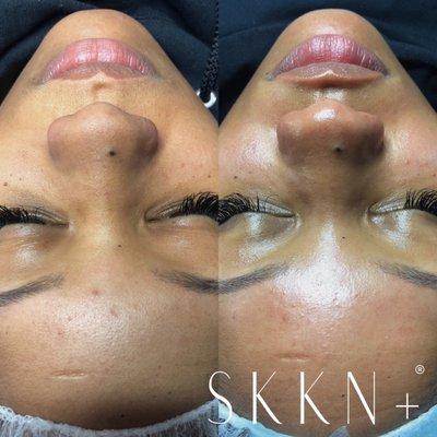 Microdermabrasion Facial