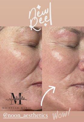 Anti-Aging advanced treatment. Instant results!