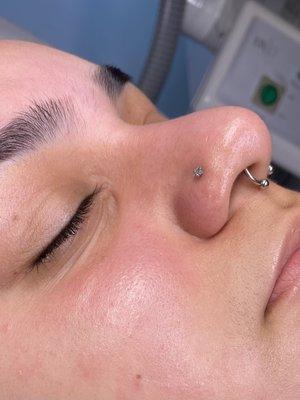 Deep Pore Teen Treatment