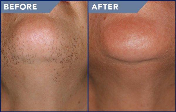 Laser hair removal