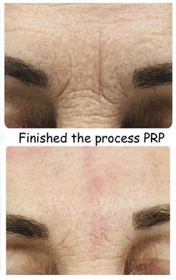 plasma-rich protein (PRP) facial