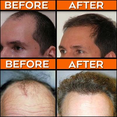 NeoGraft is a revolutionary hair restoration technique that is more efficient and faster than traditional methods...