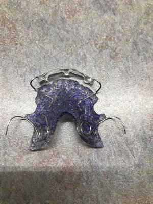 Molar distalizing appliance with purple glitter.