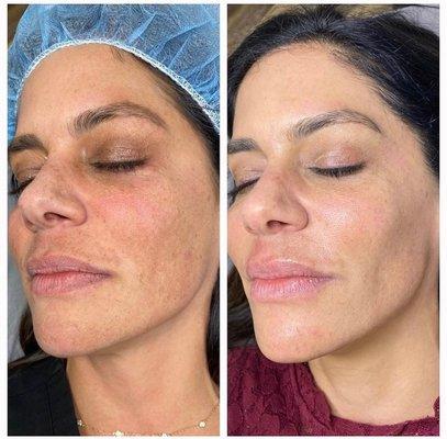 Before & After of a VI Peel. Perfect treatment for hyperpigmentation, melasma  and fine lines.