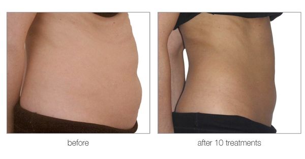 Beautiful results WITHOUT surgery/recovery/pain and downtime!