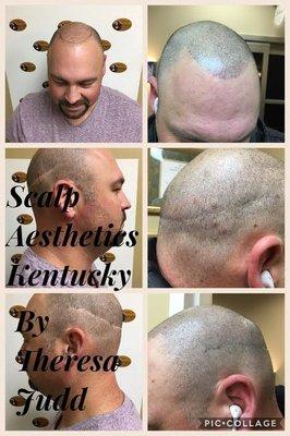 Scalp Micropigmentation Before & After 201-970-3244