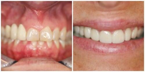 Cosmetic Dentistry can transform your smile!