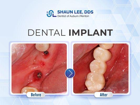 Shaun Lee, DDS Family Emergency Dental Implants of Auburn | 1320 8th St NE Ste. 103, Auburn, WA 98002 |(253)939-3440