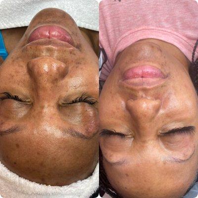 Microdermabrasion aides in hyperpigmentation correction, fine lines, wrinkles and exfoliation of dead skin.