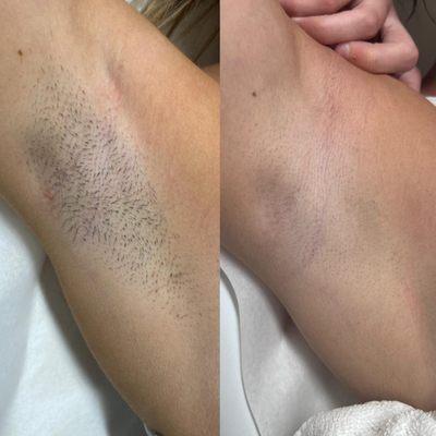 Before and after - underarms laser hair removal