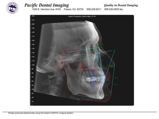 Cephalometric Tracing