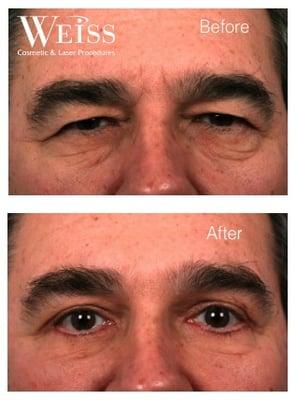 Before and after images of eyelid surgery