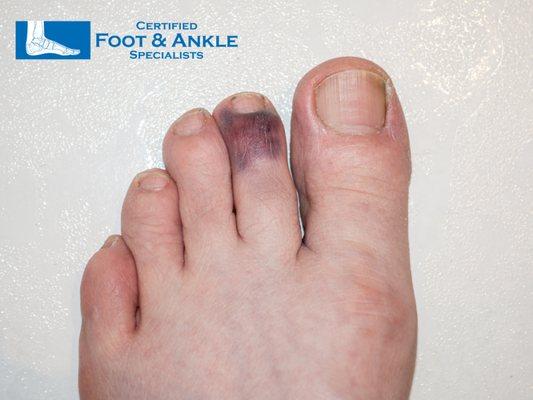 broken toe treatment