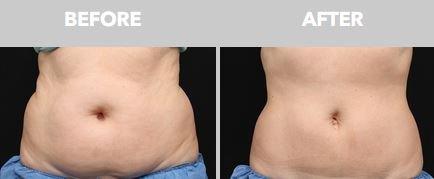 coolsculpting