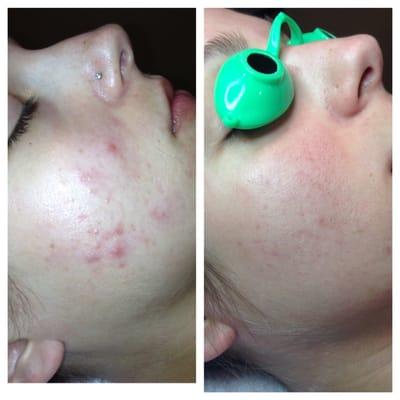 Acne can be cleared beautifully in 3-4 months with my acne boot camp program!