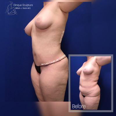 7A ATW with a Mini Tummy Tuck with Lateral Extension. The patient is between (20-25) years old.