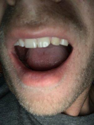 This is what a fixed chipped tooth looks like when you visit this dentist!