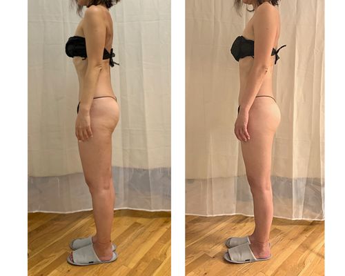 with one session of  detox booster body wrap treatment. posture became closer to neutral position.  cellulite texture is improved.