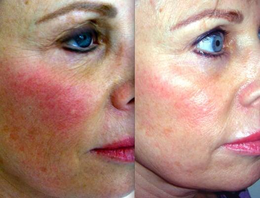 Actual Patient:  Photo Genesis and Laser Genesis treating redness and pigmentation.