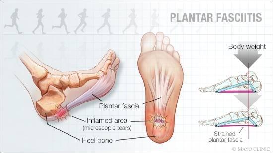 Plantar Fasciitis