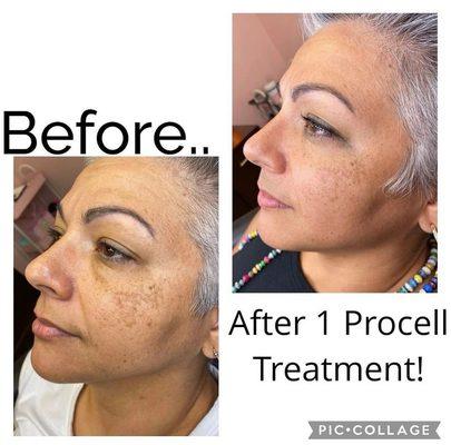 Procell skin treatment