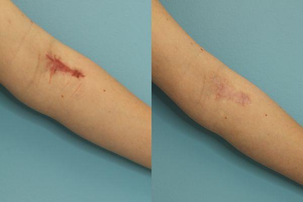 Photofractional (scar)